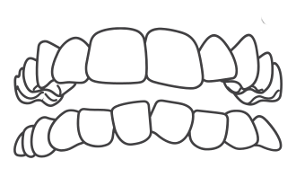 imagem de Dentes Apinhados