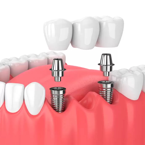 Imagem Implantes